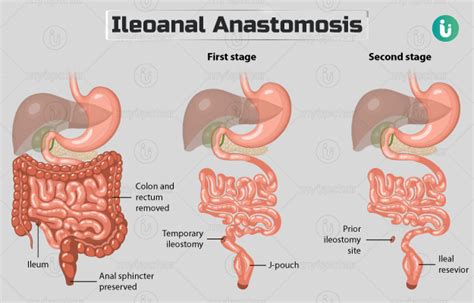 Ileoanal anastomosis (J.